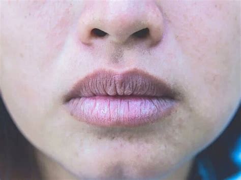 dudaklar neden beyazlar